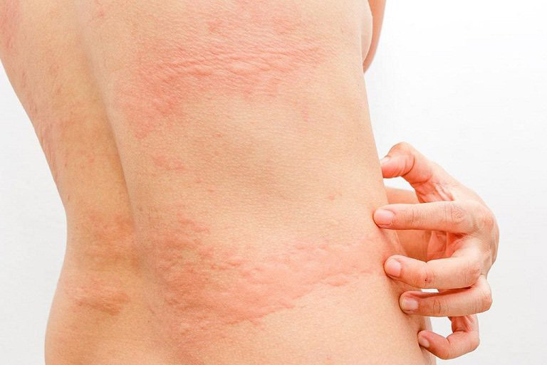 Lá mề đay có tác dụng đẩy lùi tình trạng ngứa ngáy, sưng đỏ trên da