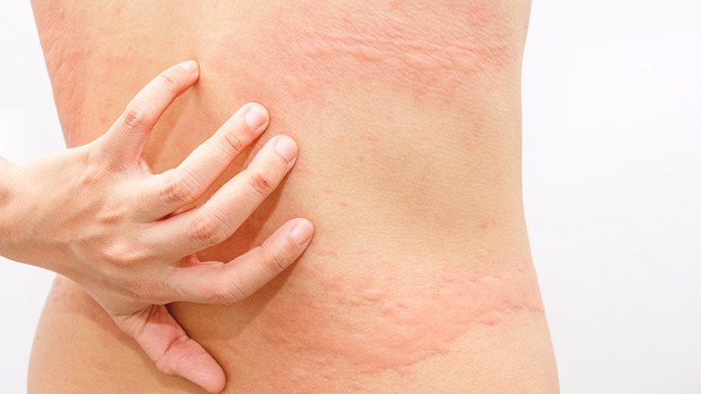 triệu chứng nổi mề đay