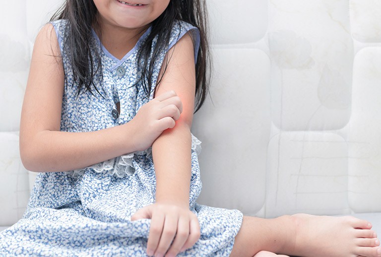 Nổi mề đay là bệnh lý xảy ra khá phổ biến ở trẻ em, gây ảnh hưởng đến đời sống hàng ngày của trẻ