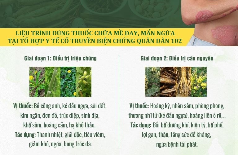 Phác đồ xử lý mề đay Quân dân 102 được tối ưu thành 2 giai đoạn Phác đồ xử lý mề đay Quân dân 102 được tối ưu thành 2 giai đoạn