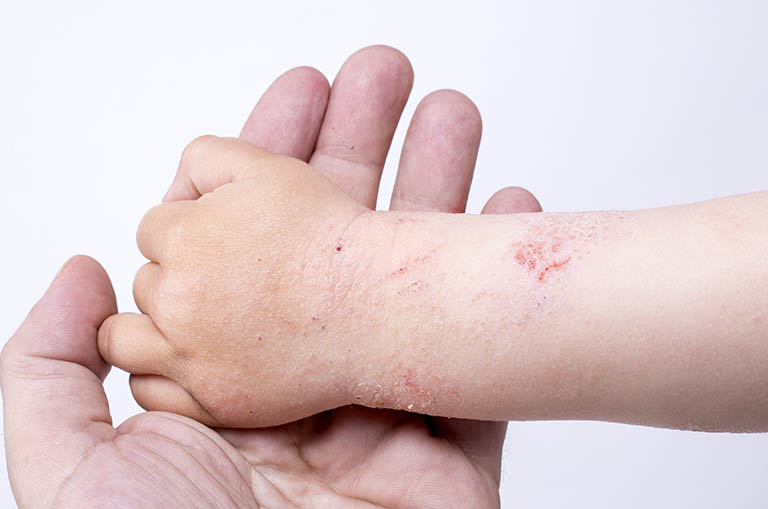 Bệnh á sừng ở trẻ em: Cách điều trị và phòng ngừa tái phát