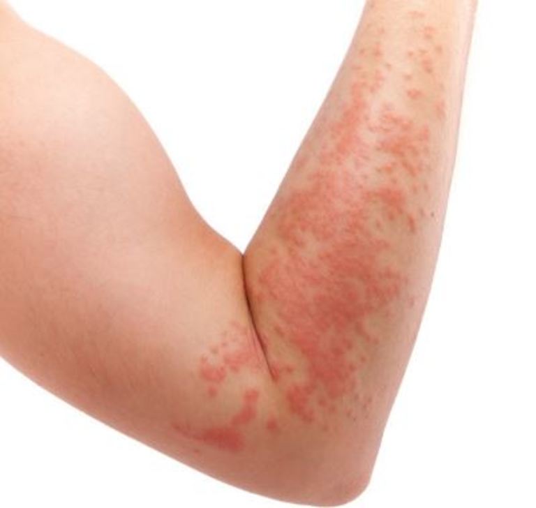 Chàm là một trong những bệnh lý thường gặp khiến da bị nổi mẩn ngứa theo từng mảng.