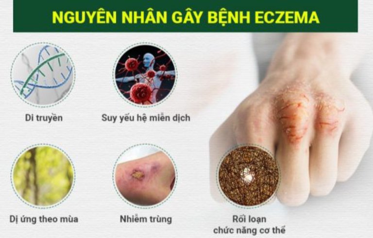 Bệnh chàm Eczema