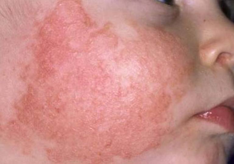 Bệnh eczema ở trẻ sơ sinh trong một số trường hợp có thể bị nhiễm trùng liên cầu khuẩn.