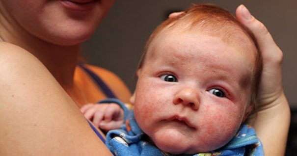 Bệnh Eczema xảy ra ở trẻ sơ sinh dễ chuyển biến phức tạp vì hệ miễn dịch của bé còn yếu.
