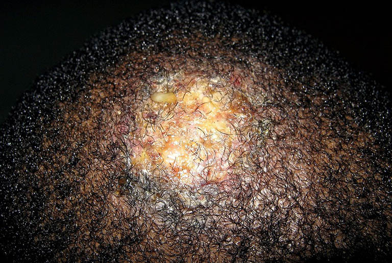 Bệnh nấm da đầu Kerion