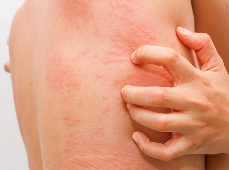Mề đay là một trong những bệnh về da thường gây ngứa ngáy dữ dội và lan rộng toàn cơ thể.
