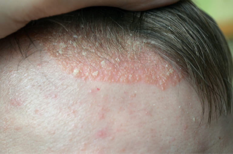Biểu hiện ban đầu thường gặp của người bị bệnh vẩy nến là tình trạng bong tróc da liên tục.