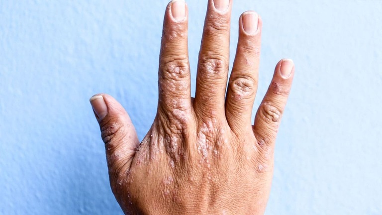 8 cách chữa chàm khô dân gian đến nay vẫn còn hiệu quả