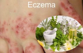 cây thuốc chữa bệnh Eczema