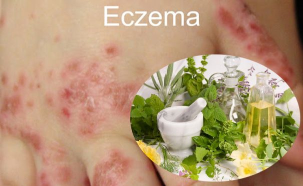 cây thuốc chữa bệnh Eczema