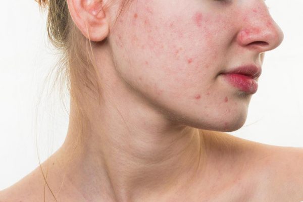 dị ứng thời tiết ở mặt