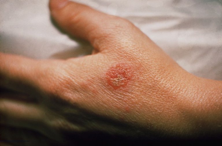 Bệnh eczema có lây không