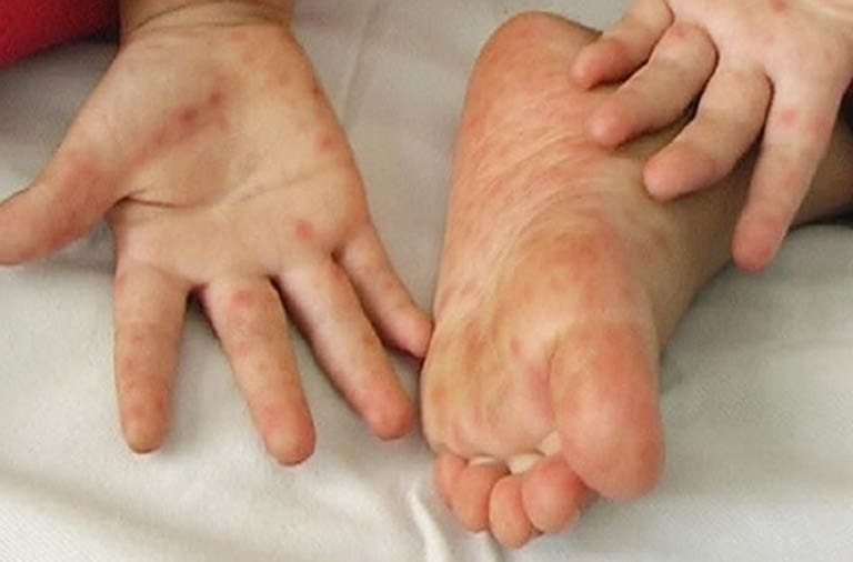 Lòng bàn tay bị ngứa nổi hột là bệnh gì