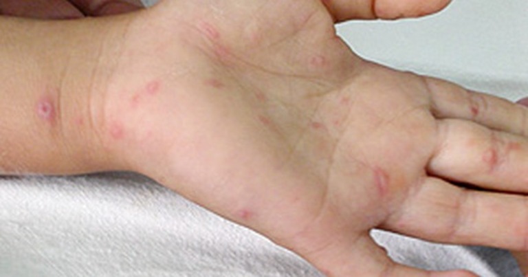 Chàm ở tay và chân thường không nguy hiểm và cũng không lây cho người khác. Tuy nhiên, nó phát triển nhanh trên vùng da của người bệnh.