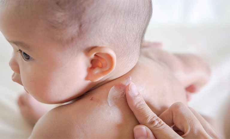 Việc sử dụng thuốc điều trị cho trẻ sơ sinh bị bệnh eczema cần có chỉ định của bác sĩ, bao gồm cả những loại bôi ngoài da hoặc có nguồn gốc từ thiên nhiên.