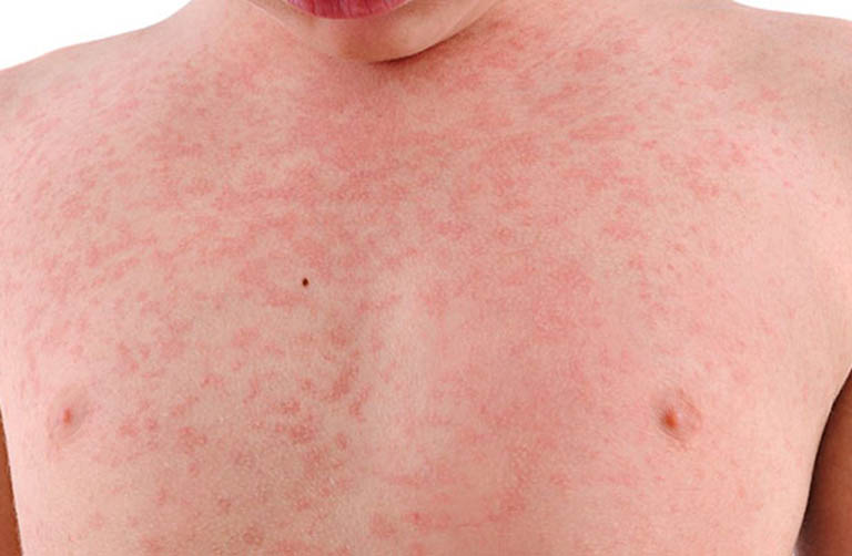 Nổi mẩn đỏ khắp người không sốt không ngứa là bị gì? Có nguy hiểm?