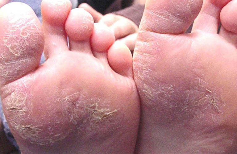Triệu chứng của bệnh viêm da cơ địa ở chân