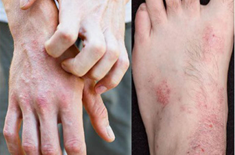 Bệnh viêm da cơ địa ở tay, chân - Cách điều trị và phòng ngừa