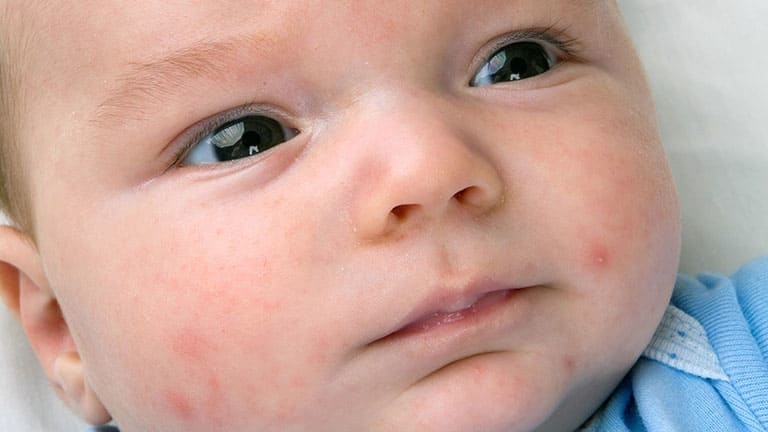Viêm da tiếp xúc kích ứng ở trẻ em và cách điều trị