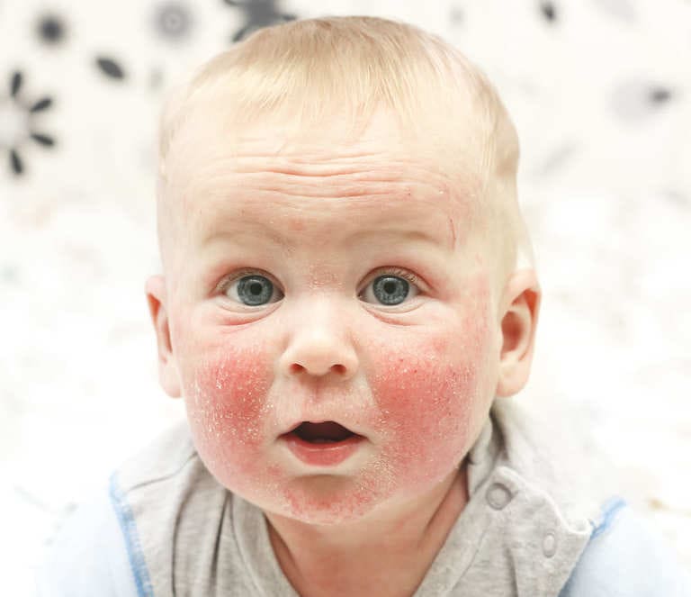 Viêm da tiếp xúc dị ứng ở trẻ em và cách điều trị