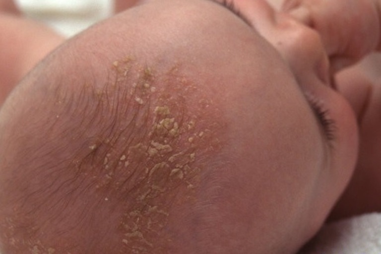 "Cứt trâu" ở trẻ sơ sinh là một trong những biến chứng của viêm da tiết bã - một loại bệnh eczema.