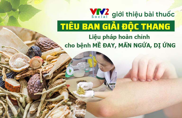 VTV2 giới thiệu bài thuốc đặc trị mề đay, dị ứng