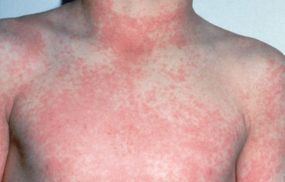 Bé bị sốt nổi mẩn đỏ khắp người triệu chứng đặc trưng của bệnh gì?