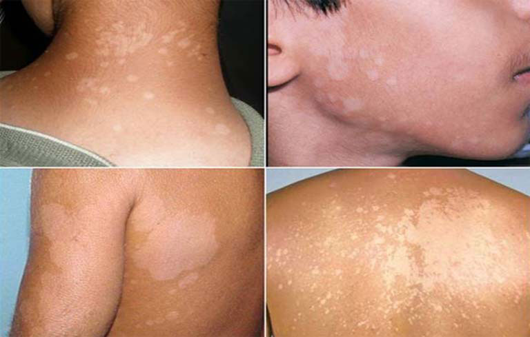 Lang ben là bệnh về da thường gặp ở Việt Nam