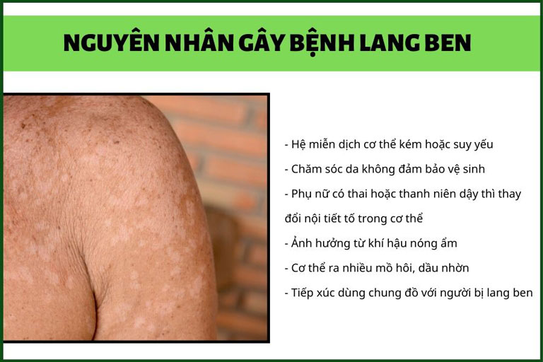 Nguyên nhân gây bệnh lang ben