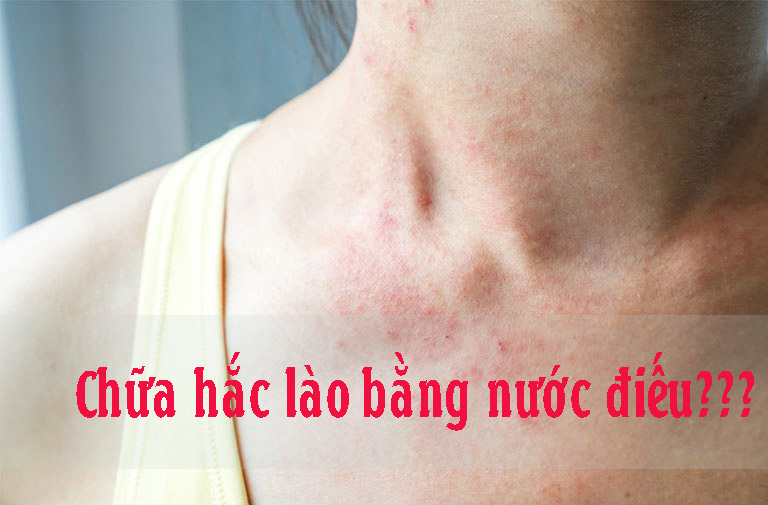 chữa hắc lào bằng nước điếu