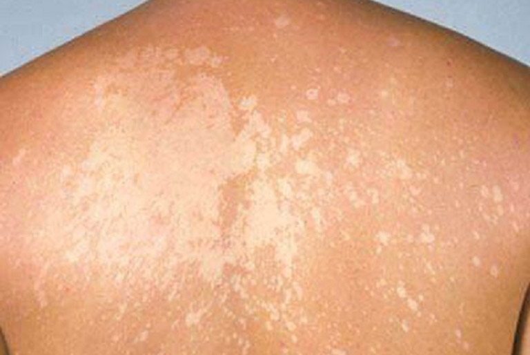 Bệnh lang ben có tự khỏi không là băn khoăn của nhiều người