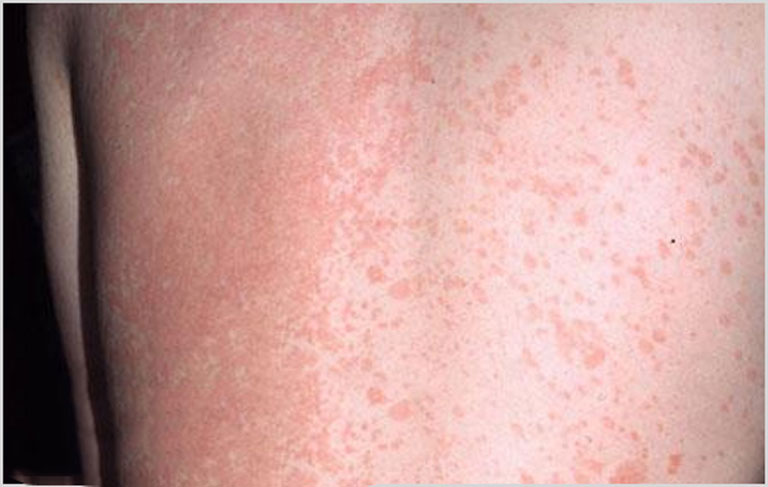 Lang ben đỏ không ảnh hưởng đến sức khỏe nhưng dễ dàng lây lan sang vùng da khác