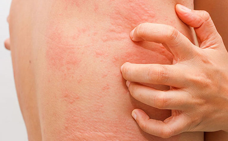 Có thể gặp một số tác dụng phụ khi sử dụng Tomax genta trị hắc lào