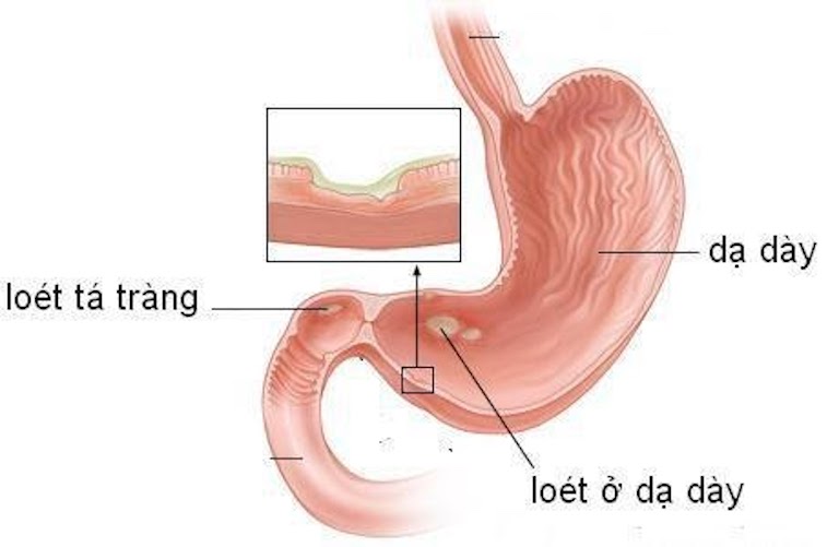 Viêm loét dạ dày tá tràng là bệnh thường gặp ở Việt nam