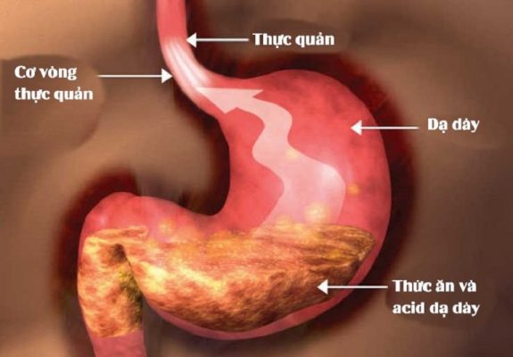 Bệnh trào ngược dạ dày có chữa khỏi được không?