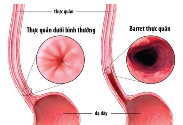 Barrett thực quản là biến chứng nguy hiểm của bệnh trào ngược dạ dày