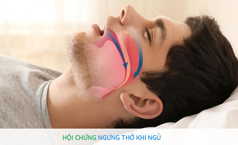 Trào ngược dạ dày có thể gây ngưng thở, làm suy giảm thần kinh và sức khỏe