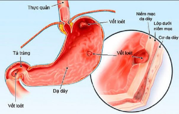 Viêm loét dạ dày cấp tính