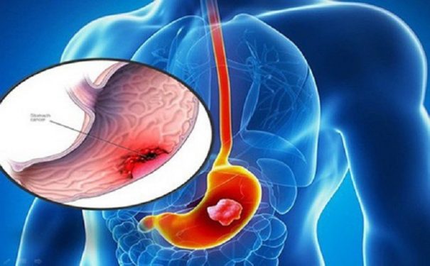 Vi khuẩn HP gây ung thư dạ dày là biến chứng rất nguy hiểm