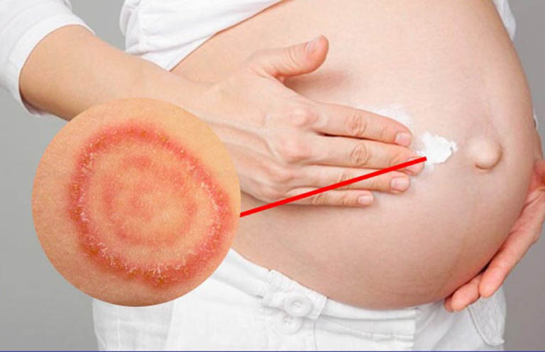 Lác đồng tiền là bệnh lý dễ xảy ra ở thai phụ do sự tấn công gây hại của vi nấm cạn