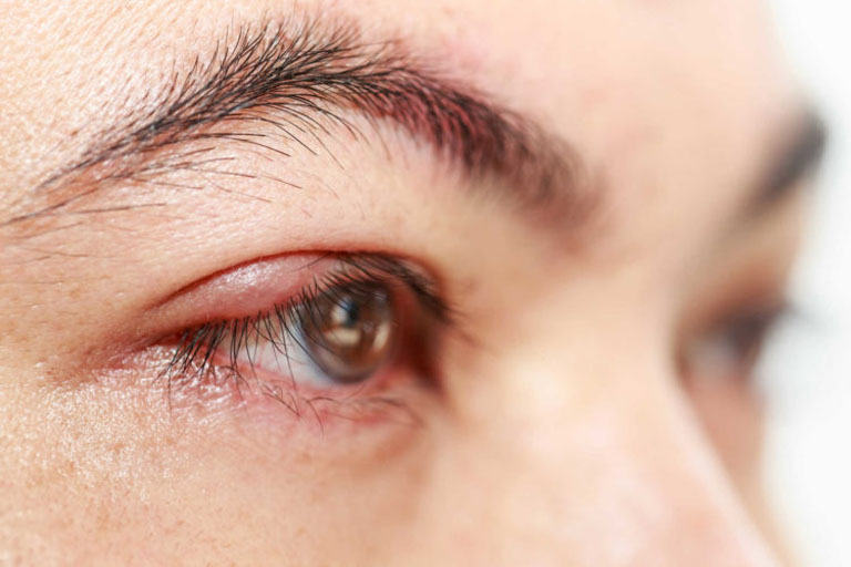 Áp xe mí mắt là biến chứng tại mắt thường gặp của bệnh viêm xoang sàng trước sau
