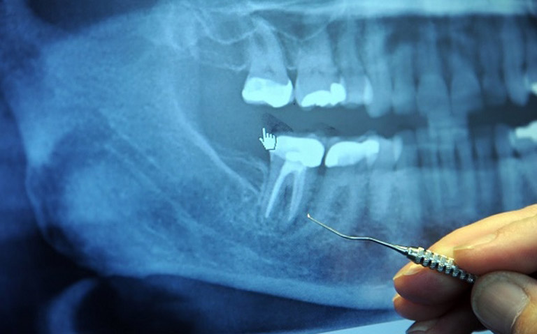 Chụp x-quang là phương pháp giúp bạn chẩn đoán được mức độ tổn thương tại răng và nguyên nhân gây ra bệnh viêm xoang hàm