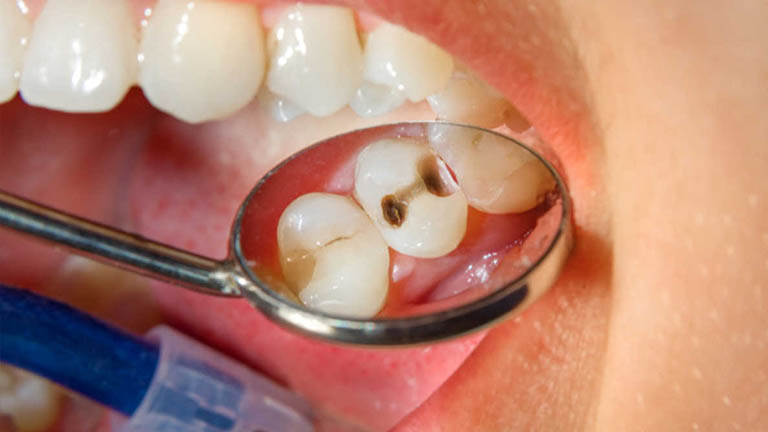 Viêm xoang hàm do răng thường khởi phát khi không tiến hành điều trị dứt điểm các bệnh lý nhiễm trùng răng miệng