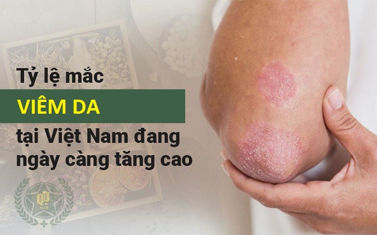 Viêm da là bệnh lý da liễu phổ biến, ảnh hưởng lớn tới tâm, sinh lý của người bệnh Viêm da là bệnh lý da liễu phổ biến, ảnh hưởng lớn tới tâm, sinh lý của người bệnh