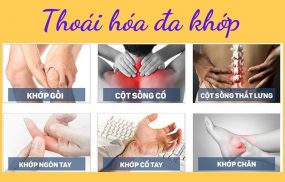 Thoái hóa đa khớp