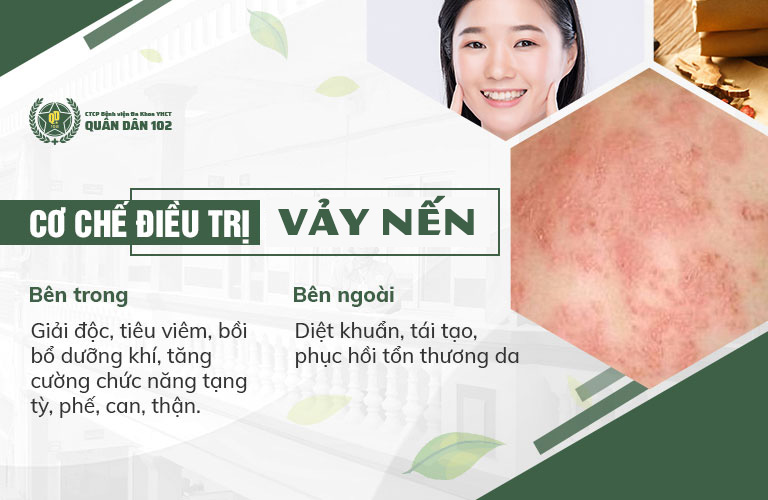 Cơ chế chữa bệnh vảy nến theo phương pháp điều trị tại Quân dân 102