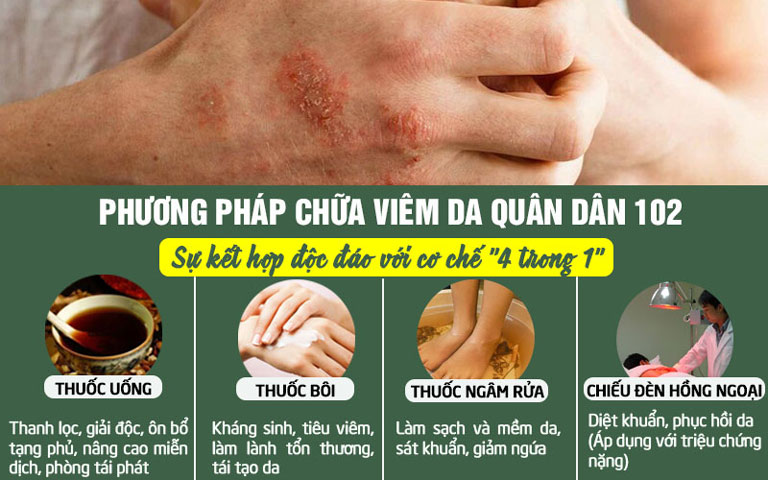 Liệu trình bài thuốc viêm da Quân dân 102 có công thức kết hợp vô cùng độc đáo, toàn diện