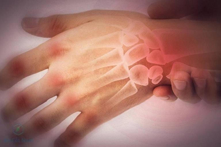 Viêm khớp cổ tay gây ra triệu chứng đau nhức âm ỉ và dữ dội