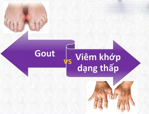 viêm khớp dạng thấp và gout
